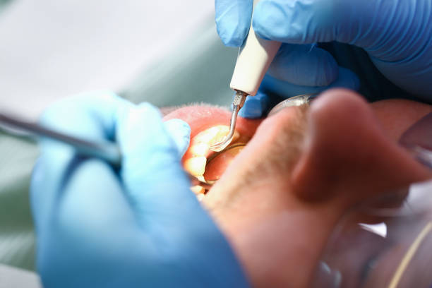 Best Emergency Tooth Extraction in Jersey Village, TX