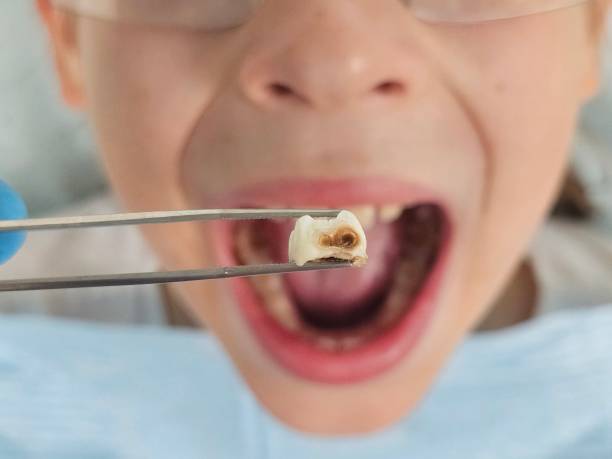 Best Emergency Wisdom Teeth Removal in Jersey Village, TX